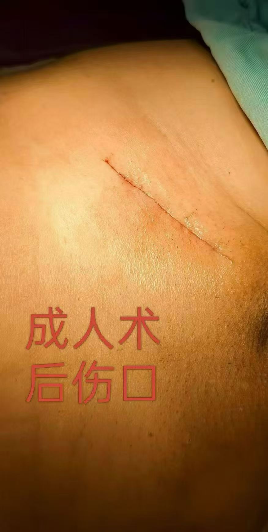 成人疝气专科治疗 技术成熟专业诊疗
