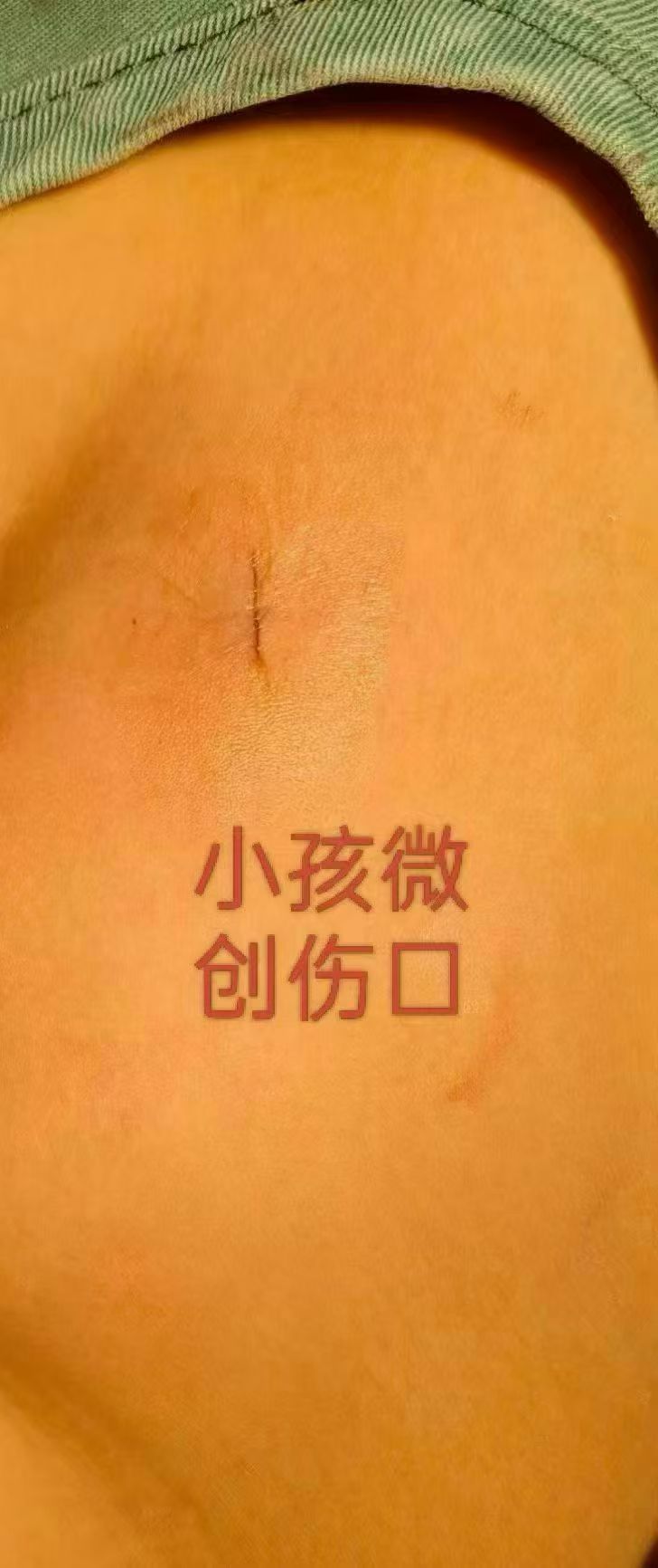 杨某淮案例